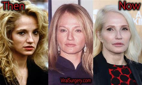 ellen barkin surgery